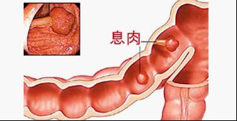 结肠息肉会变成结肠癌吗
