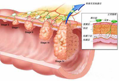 直肠息肉