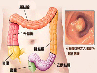 直肠息肉