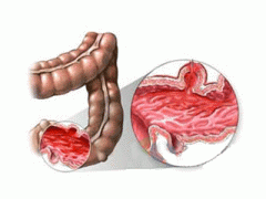 急性肠炎怎么治疗好