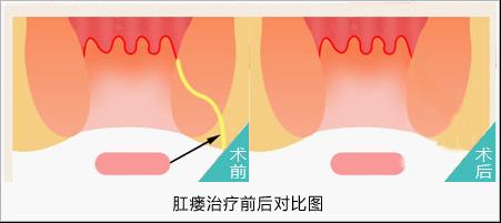 糜烂性胃炎治疗前后效果对比